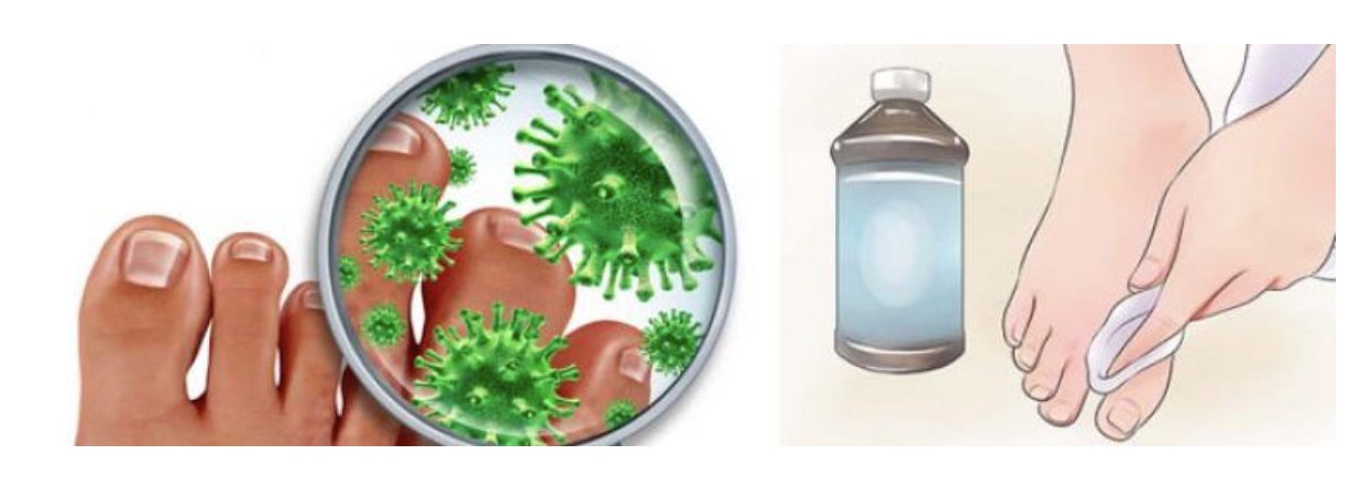 Как бороться с грибковыми заболеваниями: советы от миколога